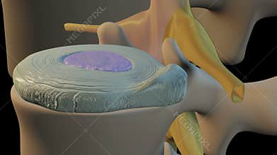 Bulging disc condition