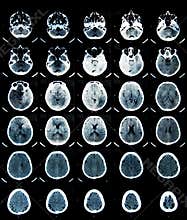 Brain CT Scan