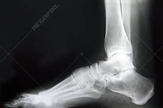 Foot x-ray