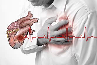 Heart attack and heart beats cardiogram