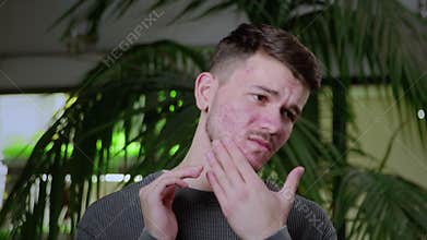 Close-up of a young man with pimples on his face. The guy is sad and pulls the skin of his face in different directions.
