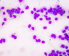 Acute myeloid leukemia (AML). Smear show monocytes and mostly blast cells