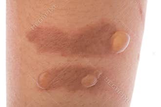 Burn blisters on the skin