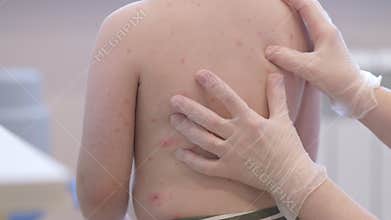 A child with a skin condition chickenpox is found enjoying themselves in a casual and playful environment