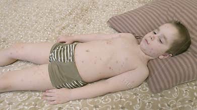 A young child relaxes on a bed with skin irritation chickenpox, surrounded by comforting bedding