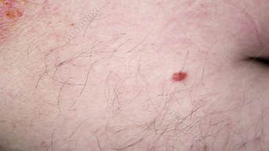 Human skin with a mole on human skin close-up. The nevus control. Male white skin body part with hair. Problem skin