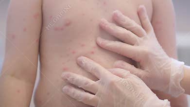Close up image of a child displaying skin rash chickenpox symptoms for consultation and awareness