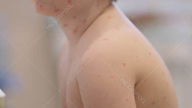 Child with a skin condition chickenpox has experience in receiving pediatric healthcare and care