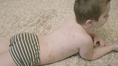 A child with a skin condition chickenpox lies on a bed, seeking comfort while monitored by parents