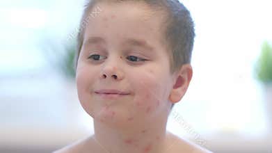 A cheerful child with skin conditions chickenpox plays joyfully in a bright, happy environment