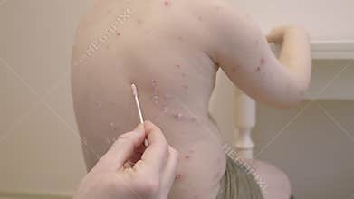 Exploring Skin Conditions chickenpox and Health Awareness within the Realm of Portrait Photography