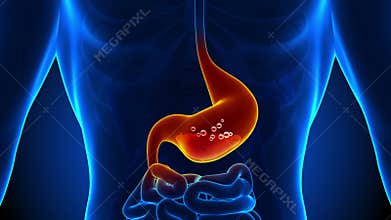 Stomach Pain - Gastric Acid - Reflux