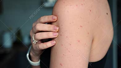 Hormonal acne on shoulder skin in adult woman. Skin problems and body changes due to hormonal imbalance concept.