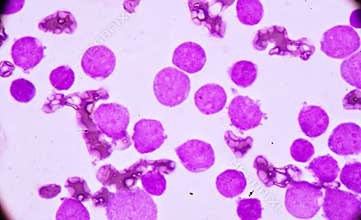Blood smear under microscopy showing on Adult acute myeloid leukemia AML is a type of cancer in which the bone marrow makes abn