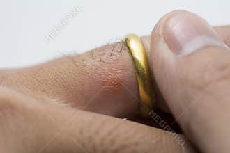 Allergic rash on finger