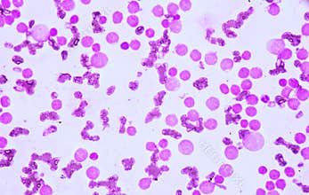 Blood smear under microscopy showing on Adult acute myeloid leukemia AML is a type of cancer in which the bone marrow makes abn