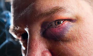 Man with black eye