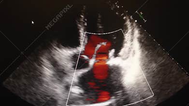 Echocardiography ultrasound examination of the heart