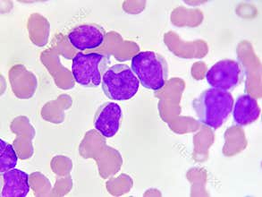 Leukemia cells