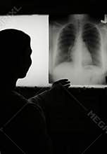 Chest Xray