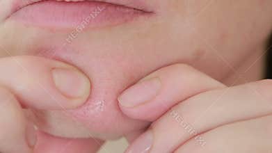Woman crushes acne on the face. oily skin. problem skin