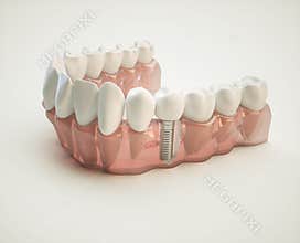 Dental implant - 3d rendering