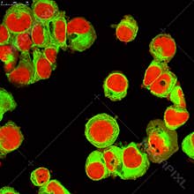Real fluorescence microscopic view of human neuroblastoma cells