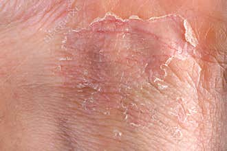 Eczema on skin