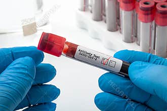 Novel coronavirus clinical antibody testing and Covid-19 diagnostic concept with doctor holding blood plasma sample used to test