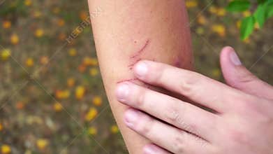 Red scratches on the skin of a man`s hand, close-up, skin damage