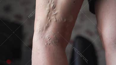 Varicose veins on woman legs indoors. Vascular health problem. Trombose on female legs