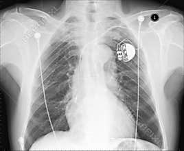 Chest X ray with pacemeker