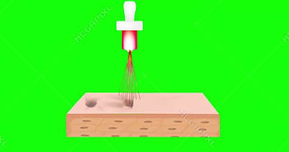 Animation of laser acne scar treatment. Laser resurfacing of skin with acne scars. Green screen animation.