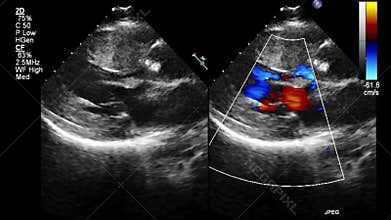 Image of the heart during transesophageal ultrasound.