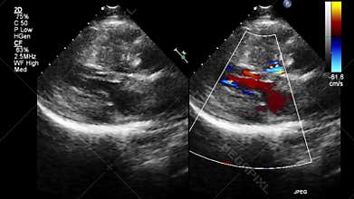 Ultrasound transesophageal examination of the heart.
