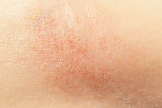 Eczema on child skin
