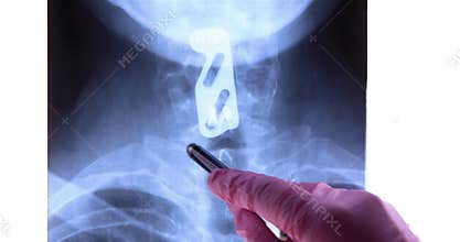 Doctor analyzing radiography of titanium plate to support the cervical spine