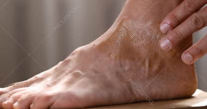 man applying skin camouflage cream on vitiligo white patches. pigment disorder
