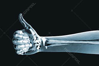 Dramatized x ray of a hand thumbs up