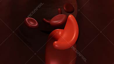 sickle cell anemia flowing inside of blood vessel