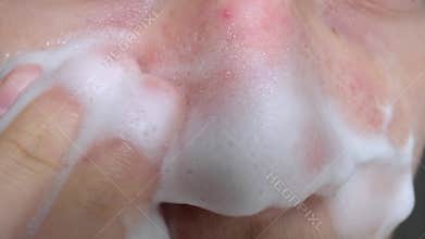 Teenage boy with acne problem washes face with foam cleanser close-up