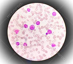 Microscopic examination of blasts or leukemia cells in blood smear of human.