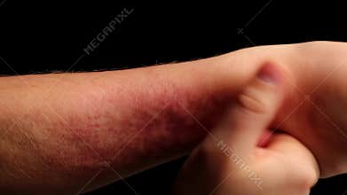 Side view of arm with patchy hives flaring in bright crimson illuminating the skin beneath then diminishing in color and