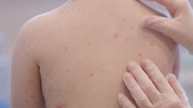 The back of a child who is affected by a skin condition chickenpox that requires medical attention and care