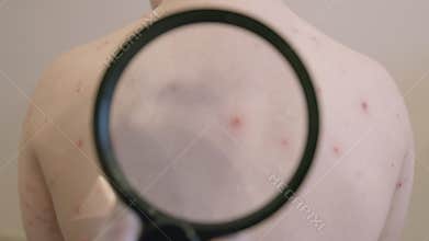 Skin Condition chickenpox That Presents with Red Spots Located on the Back Area of the Body