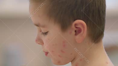 A profile view of a child with Chickenpox symptoms aids in understanding and care