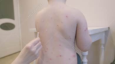 Child Experiencing Skin Condition Displaying Multiple Eruptions chickenpox Located on Their Back