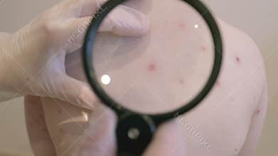 CloseUp View of a Skin Condition chickenpox on the Back A Detailed Examination and Analysis