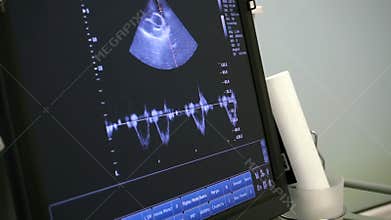 Medical vital signs monitor instrument in a hospital on anesthesia surgery monitor. ECG.