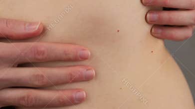 Close-up of a woman\'s abdomen showing spot of erythema migrans in lyme disease borreliosis